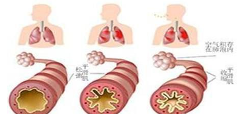 支氣管哮喘如何根治，試試這幾個(gè)哮喘偏方