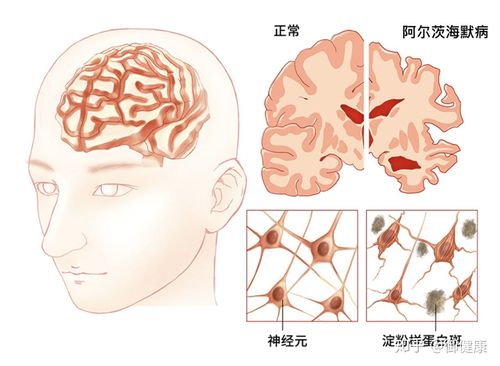 阿爾茲海默癥早期癥狀(阿爾茲海默癥早期癥狀)