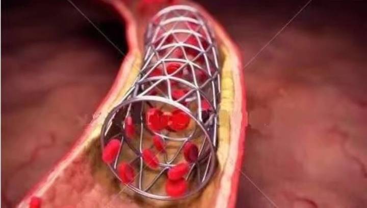 胎兒心臟支架有什么副作用(胎兒心臟支架有什么副作用嗎)
