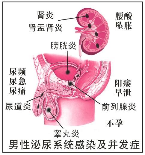 尿道炎是什么癥狀,膀胱尿道炎是什么癥狀