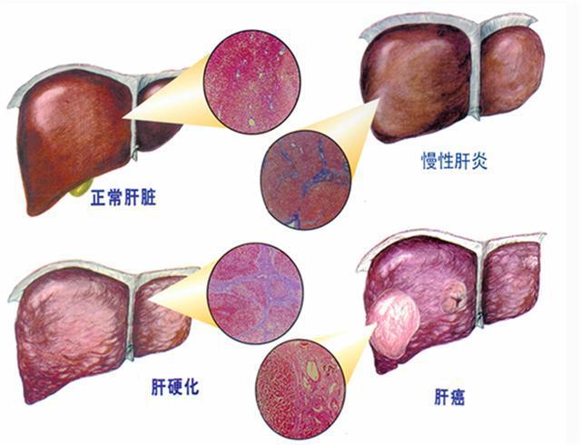 肝癌早期有什么癥狀_肝癌早期有什么癥狀嗎