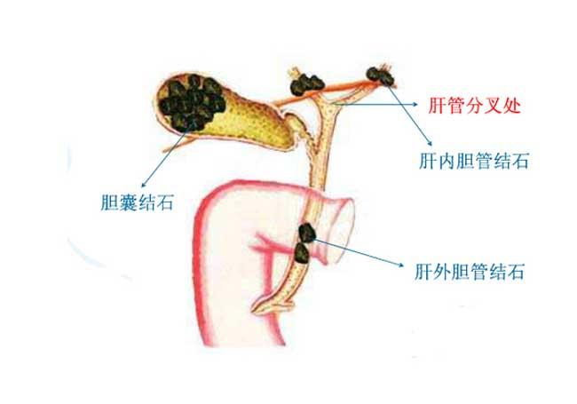 肝膽管結石癥狀(肝膽管結石有哪些癥狀出現(xiàn))