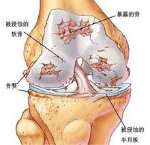 膝蓋骨質(zhì)增生的癥狀膝蓋骨質(zhì)增生的癥狀有哪些表現(xiàn)