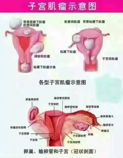 子宮肌瘤患者最主要的癥狀是(子宮肌瘤患者最主要的癥狀是什么)