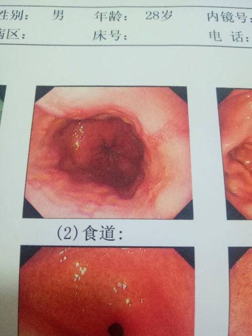 胃食管反流病癥狀-胃食管反流病癥狀分度