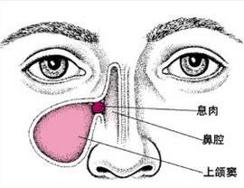 青少年鼻竇炎