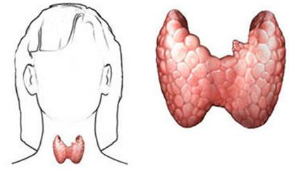 甲狀腺癌癥狀(甲狀腺癌癥狀圖片)