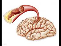 腦血管硬化的癥狀-腦血管硬化的癥狀有哪些