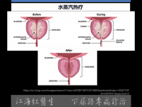 前列腺蒸汽消融術的副作用