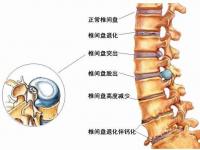 腰間盤突出早期癥狀(腰間盤突出早期癥狀怎么治療)