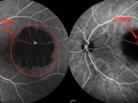 眼部ffa檢查副作用-眼部ffa檢查費(fèi)用