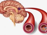 腦供血不足癥狀表現(xiàn)有哪些腦供血不足癥狀表現(xiàn)有哪些怎么治療