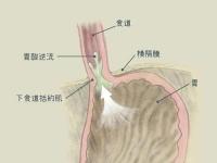 反流性食管炎癥狀_反流性食管炎癥狀及表現(xiàn)是什么一