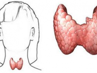 甲狀腺癌癥狀(甲狀腺癌癥狀圖片)