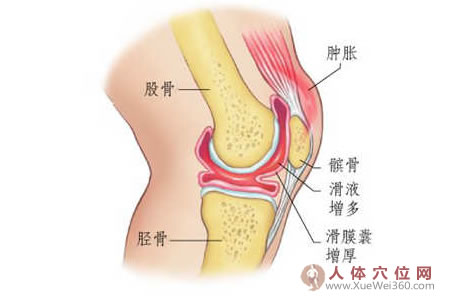 用本偏方治新舊關(guān)節(jié)積液半月可痊愈