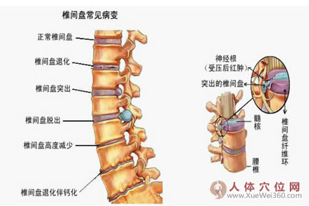 腰椎間盤突出癥