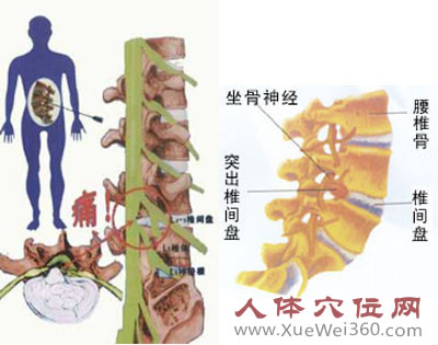 腰椎間盤突出癥