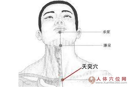 傷濕止痛膏貼天突穴治療慢性咽炎